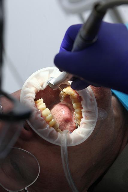 Bělení zubů po rovnátkách: Co musíte vědět?