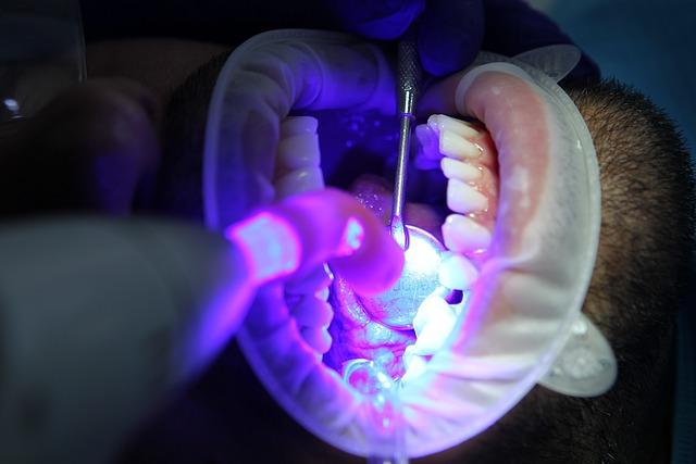 Bělení zubů s korunkou: Co musíte vědět?